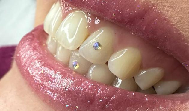 strass dentaire