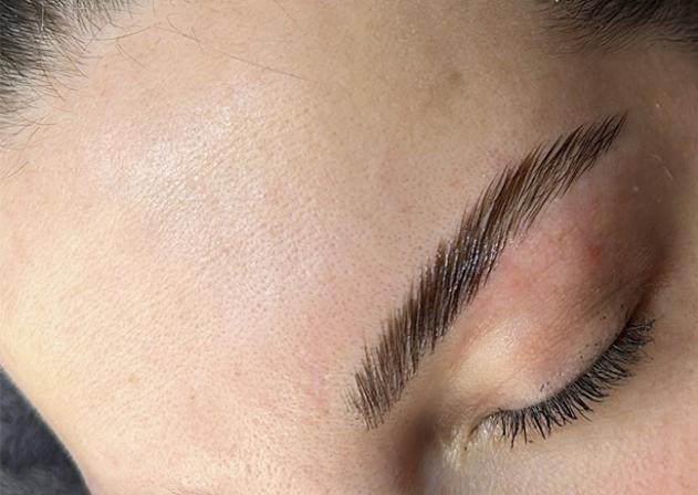 browlift