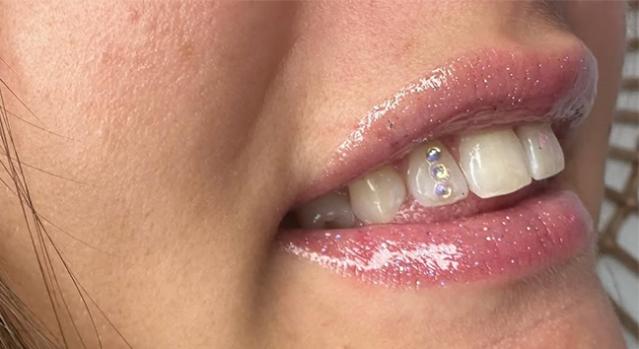 strass dentaire