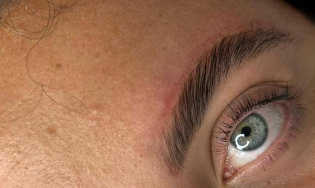 browlift