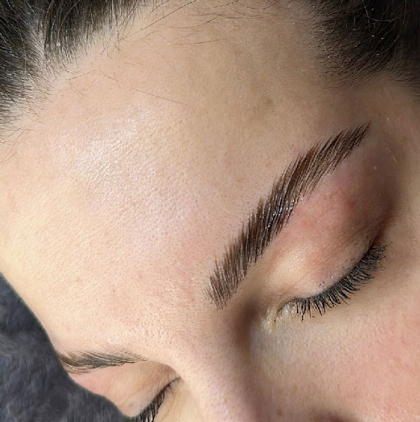 Browlift